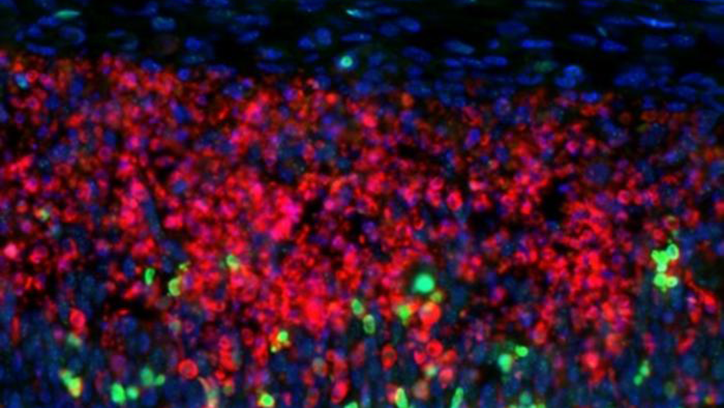 When a crucial DNA repair kit is disabled, brain cells die, providing a hint of what can go awry ...