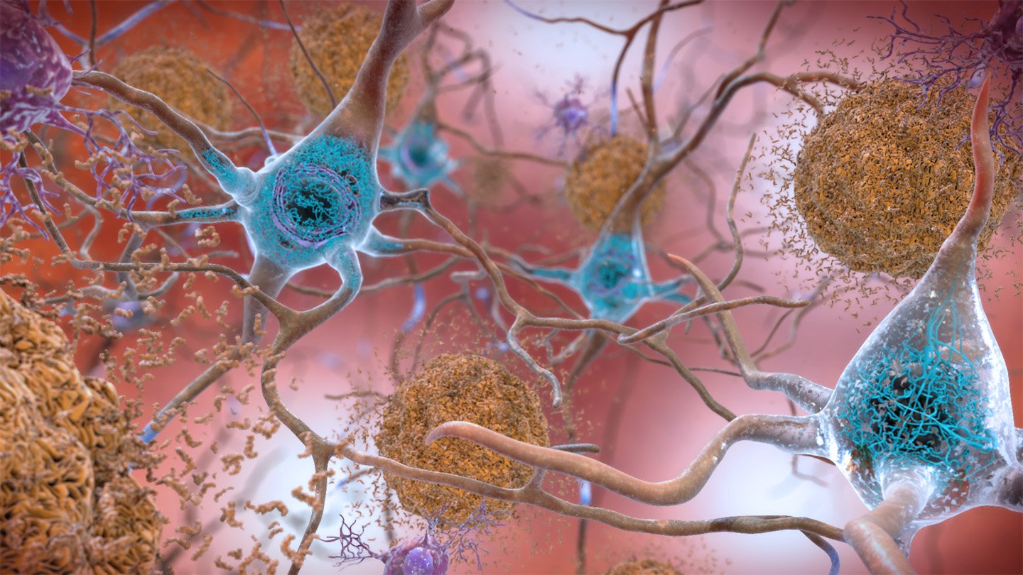 An experimental drug targets tau (seen in blue in this illustration), a protein that forms toxic ...